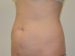 Tummy Tuck Before Patient Thumbnail 2