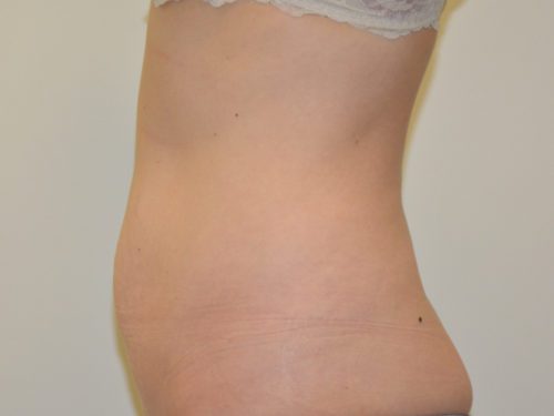 Tummy Tuck Before Patient 3