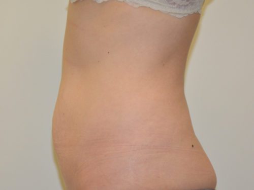 Tummy Tuck Before Patient 3