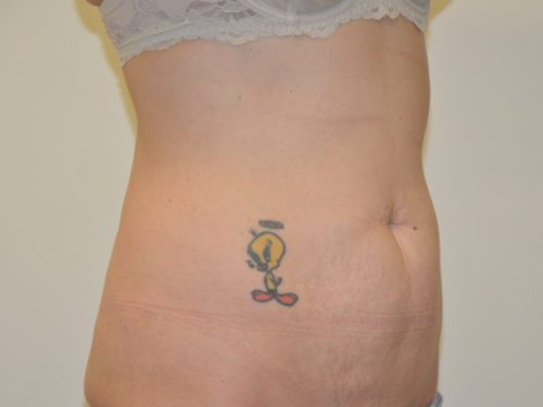 Tummy Tuck Before Patient 4