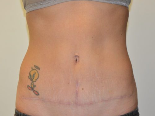 Tummy Tuck After Patient 1