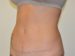 Tummy Tuck After Patient Thumbnail 2