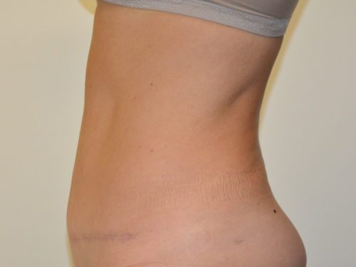 Tummy Tuck After Patient 3