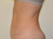 Tummy Tuck After Patient Thumbnail 3