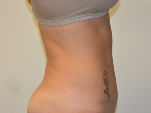 Tummy Tuck After Patient 5