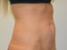 Tummy Tuck Before Patient Thumbnail 2