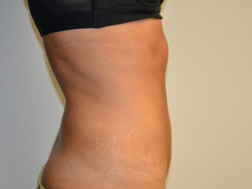 Tummy Tuck After Patient 3