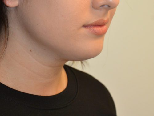 Neck Liposuction Before Patient 1