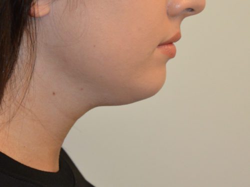 Neck Liposuction Before Patient 2