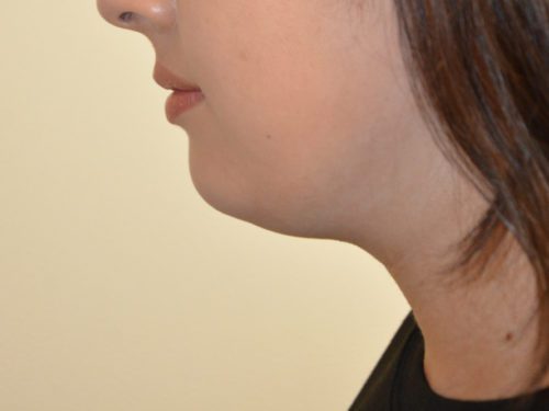 Neck Liposuction Before Patient 4