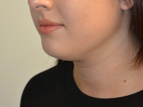 Neck Liposuction Before Patient 3