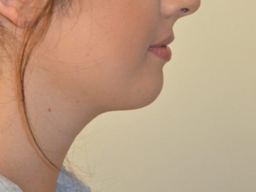 Neck Liposuction After Patient 2