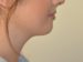 Neck Liposuction After Patient Thumbnail 2