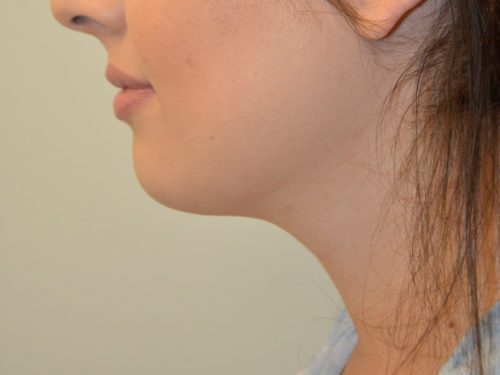 Neck Liposuction After Patient 4