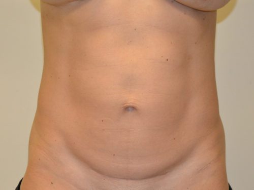 Mini Tummy Tuck Before Patient 1