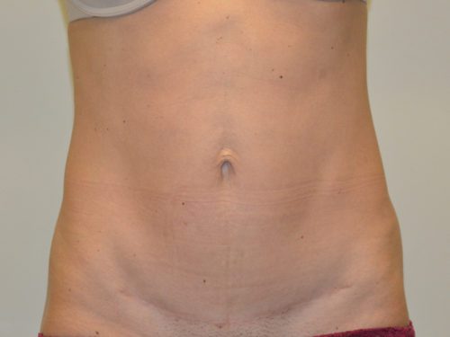 Mini Tummy Tuck After Patient 1