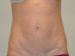 Mini Tummy Tuck After Patient Thumbnail 1