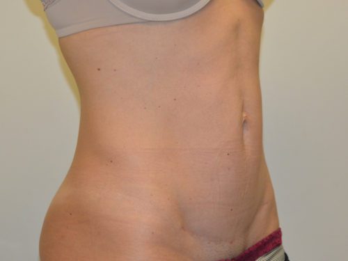 Mini Tummy Tuck After Patient 2