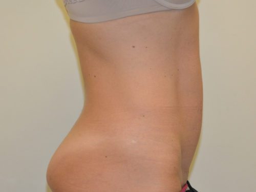 Mini Tummy Tuck After Patient 3