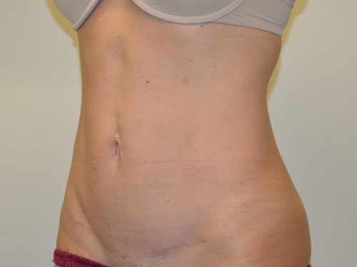 Mini Tummy Tuck After Patient 4