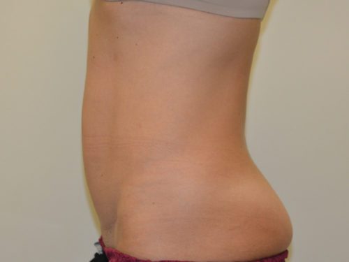 Mini Tummy Tuck After Patient 5