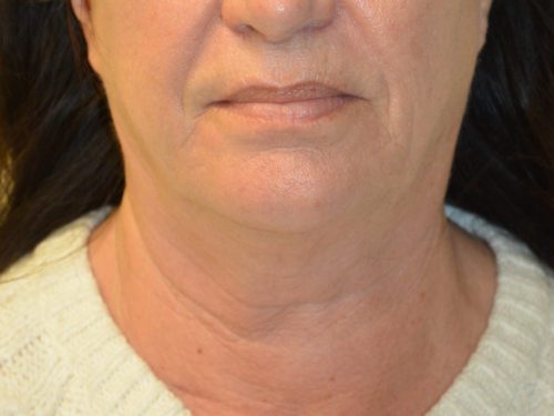 Facelift Before Patient 1