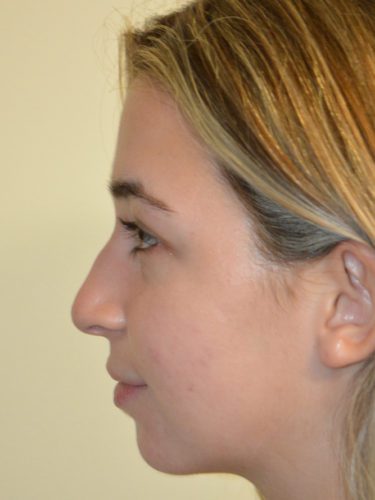 Rhinoplasty Before Patient 1