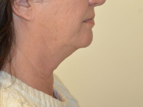 Facelift Before Patient 5