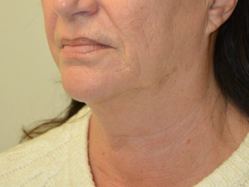 Facelift Before Patient 2