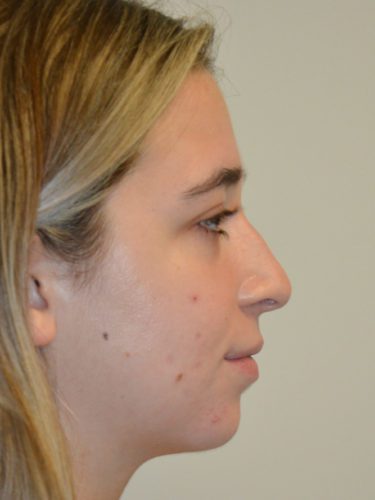 Rhinoplasty Before Patient 5