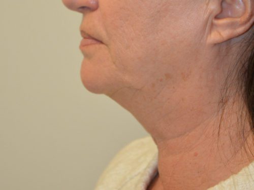 Facelift Before Patient 3