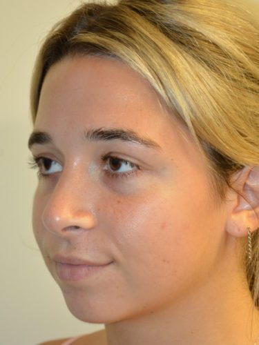 Rhinoplasty After Patient 2