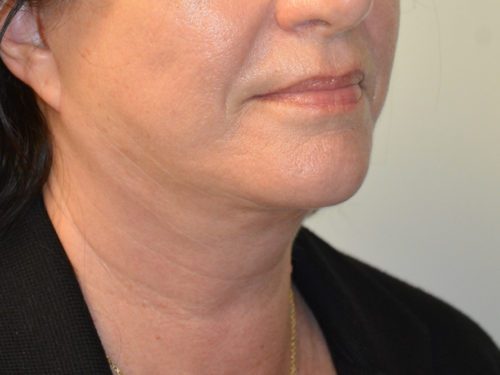 Facelift After Patient 4