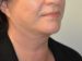 Facelift After Patient Thumbnail 4