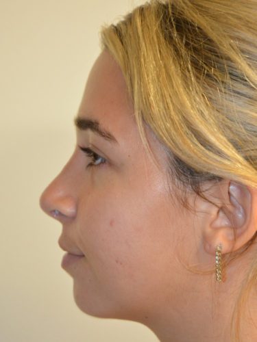 Rhinoplasty After Patient 1