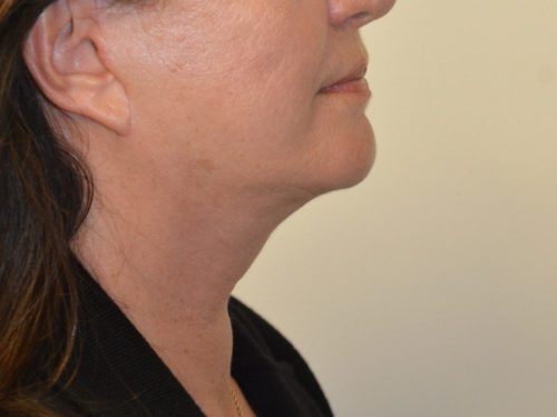 Facelift After Patient 5
