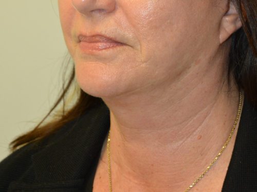 Facelift After Patient 2