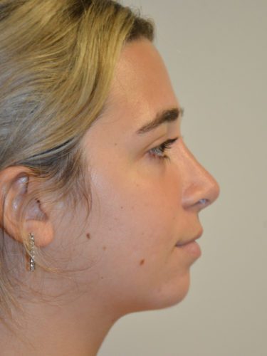 Rhinoplasty After Patient 5