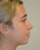 Rhinoplasty After Patient Thumbnail 5