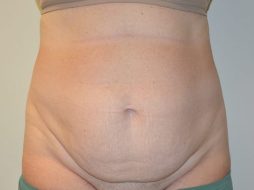 Tummy Tuck Before Patient 1