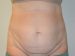 Tummy Tuck Before Patient Thumbnail 1