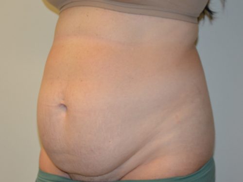 Tummy Tuck Before Patient 2