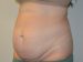 Tummy Tuck Before Patient Thumbnail 2