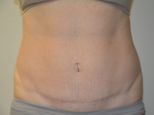 Tummy Tuck After Patient 1