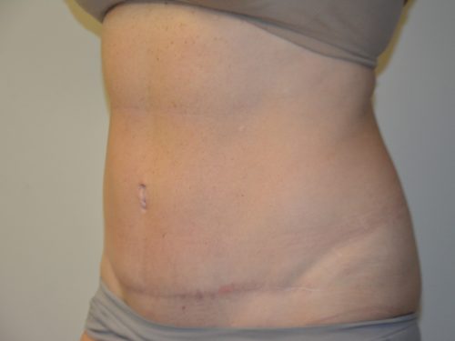 Tummy Tuck After Patient 2