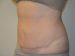 Tummy Tuck After Patient Thumbnail 2