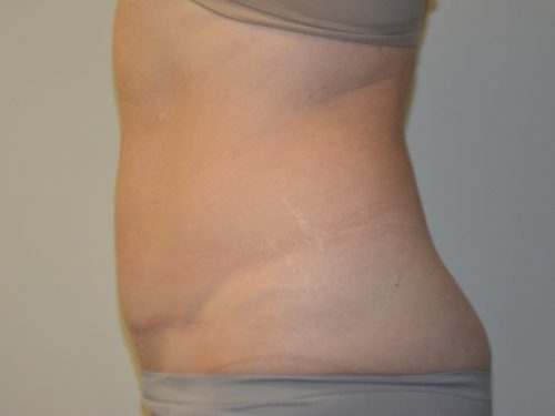 Tummy Tuck After Patient 3