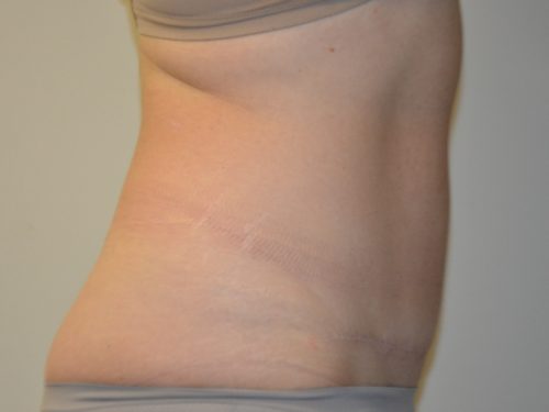 Tummy Tuck After Patient 4