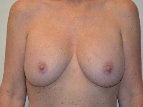 Breast Implant Removal Before Patient 1