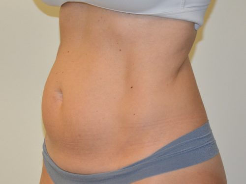 Liposuction Before Patient 2